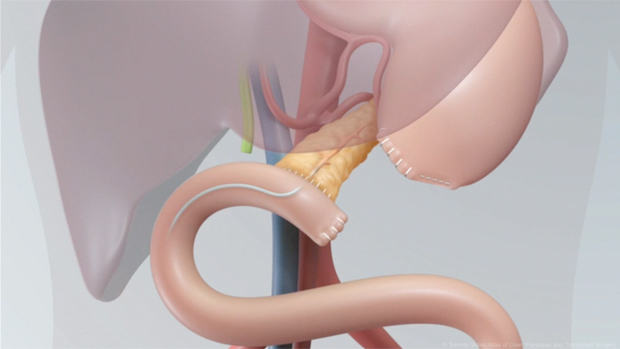 Whipple pancreatic cancer
