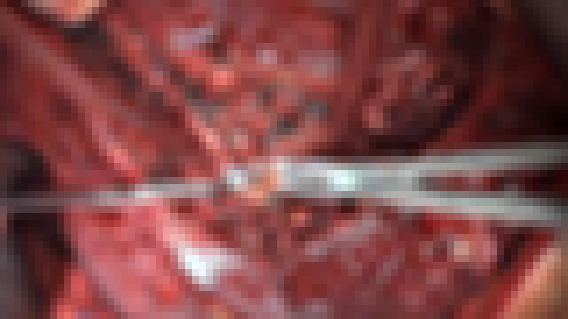 Video Editing Tips for Surgeons, Pt. 2: Image Compression Video Editing Tips for Surgeons, Pt. 2: Image Compression
